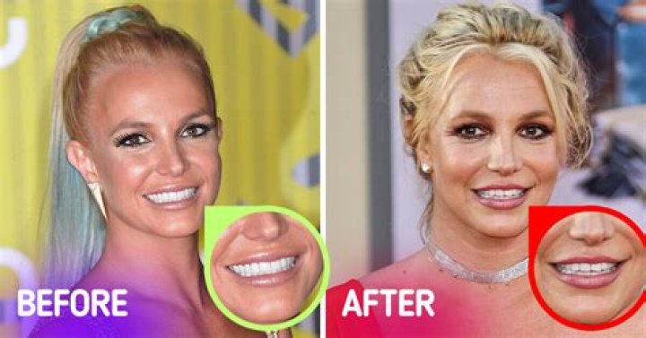 Does Jamie Lynn Spears Have Fake Teeth?